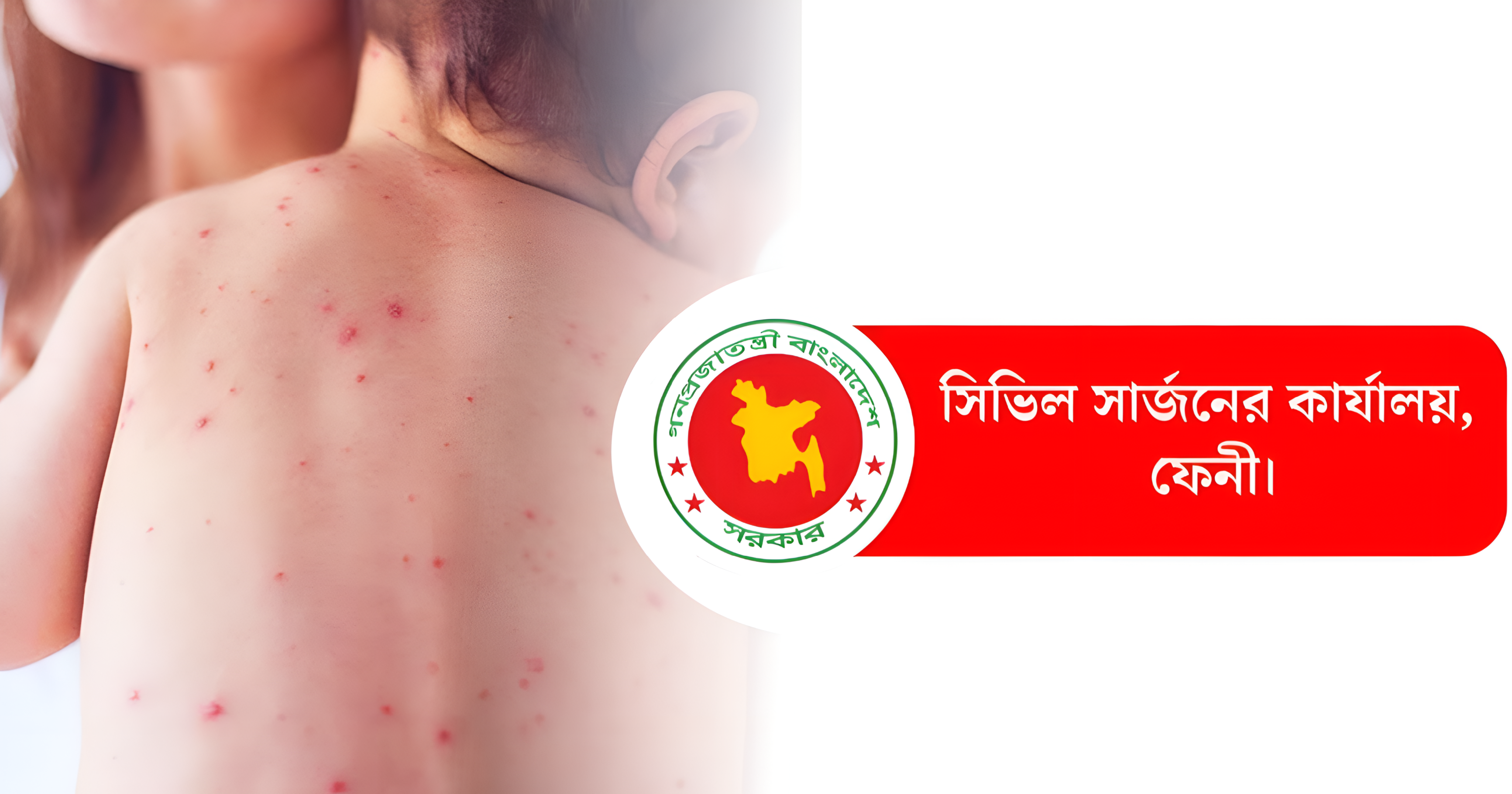 ফেনীতে এখনো শনাক্ত হয়নি হাম, আতঙ্কিত না হওয়ার আহ্বান